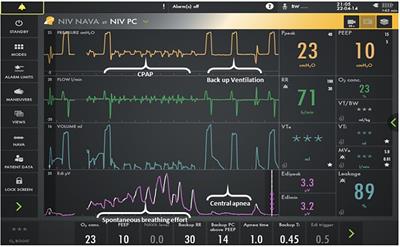 Evaluation of NAVA-PAP in premature neonates with apnea of prematurity: minimal backup ventilation and clinically significant events